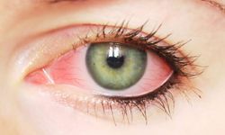 Göz kanlanması nedir? Göz kanlanması nedenleri